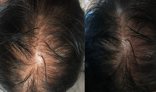 hair loss mesotherapy before after mississauga oakville